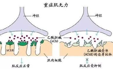 治疗重症肌无力（MG）有哪些药？药厂实拍