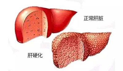 <b>奥贝胆酸能逆转肝硬化吗？</b>药厂实拍