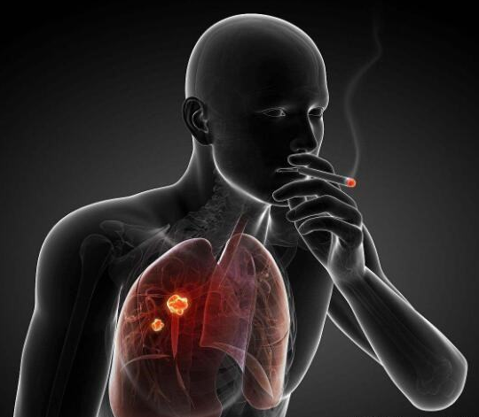 非小细胞肺癌(NSCLC)最新靶向药物有哪些？