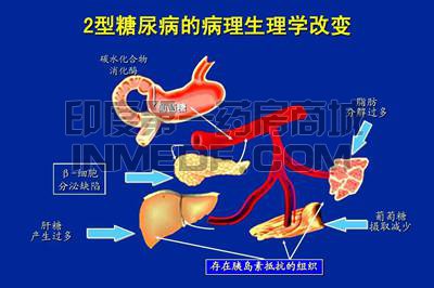 2型糖尿病