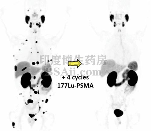 前列腺癌新药Pylarify（piflufolastat F 18）注射剂FDA获批