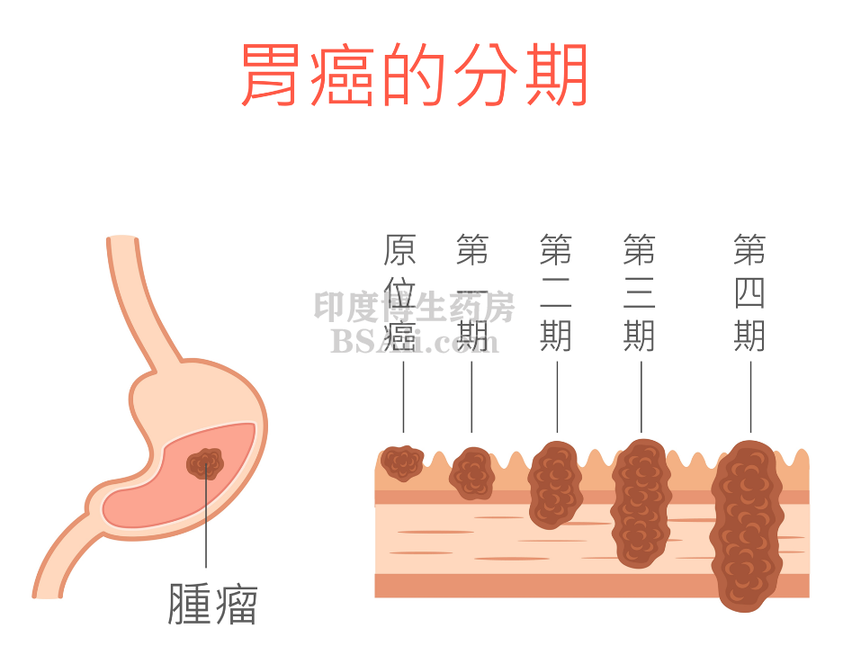 胃癌患者晚期有些什么明显的临