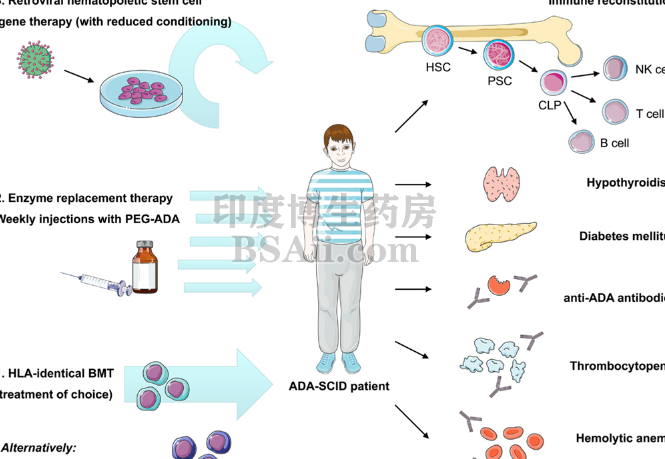 原发性联合免疫缺陷(CID)