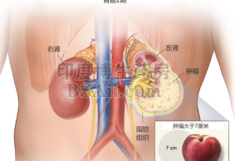 肾癌病人的饮食要怎么吃？药厂实拍