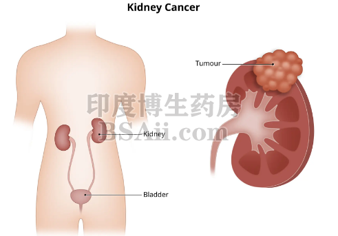 肾癌会慢慢发生转移吗？药厂实拍