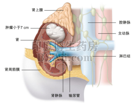 肾癌发展到晚期可以活多长时间？药厂实拍