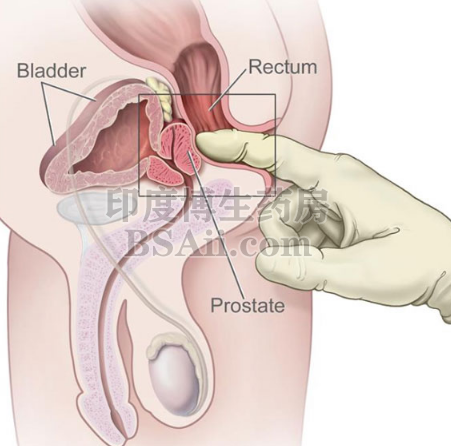 什么人容易得前列腺癌？药厂实拍