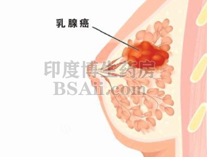 乳腺癌放疗后感染肺炎该如何治疗？药厂实拍