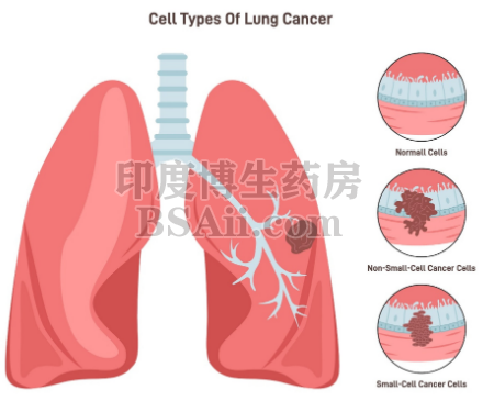 肺癌转移能活多久？药厂实拍