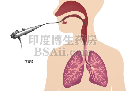 早期肺腺癌手术后最容易复发时间？药厂实拍