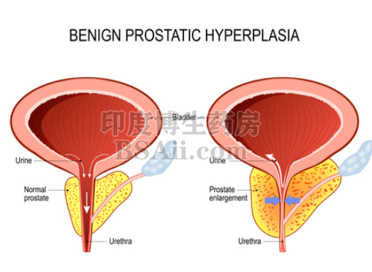 如何诊断前列腺肥大（BPH）？