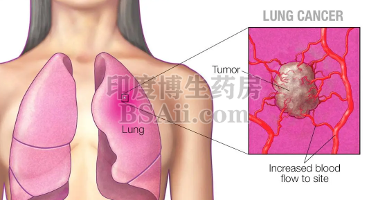 肺癌最爱的4类人群 希望你不在其中！药厂实拍