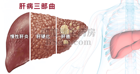 肝癌多数是拖出来的 2处发臭、2处疼痛药厂实拍