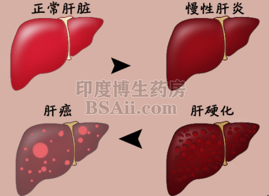 健康 | 糖尿病与肝癌有怎样的关系药厂实拍