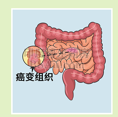 小肠癌