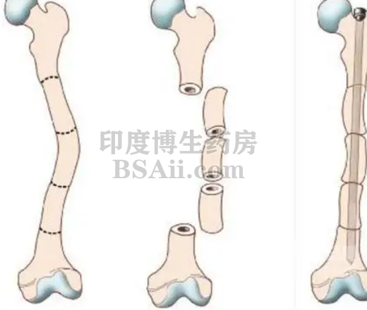 <b>5种治疗成骨不全症(OI)的药物</b>药厂实拍