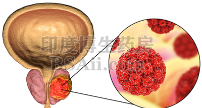 <b>治疗前列腺癌的方法/药物推荐</b>