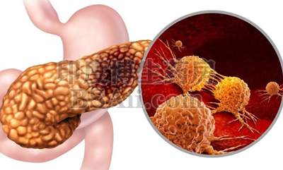 5款治疗胰腺癌的靶向药/免疫药