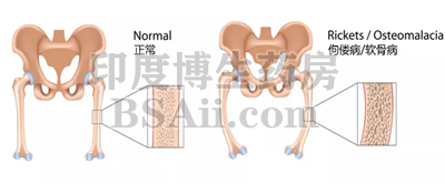 <b>3种治疗低磷性佝偻病(PRS)的药物</b>药厂实拍