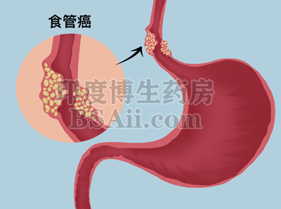 10种治疗食管癌(EC)的靶向药/免疫药物