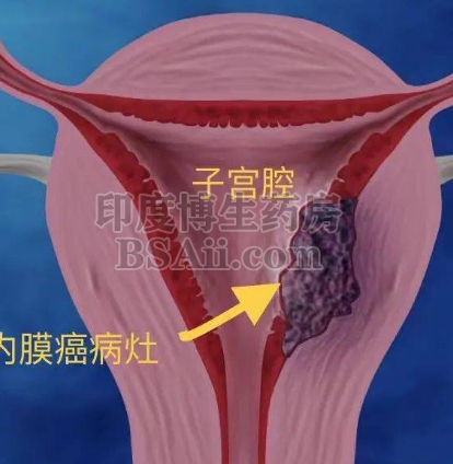 7种治疗子宫内膜癌(EC)的靶向药/免疫单抗