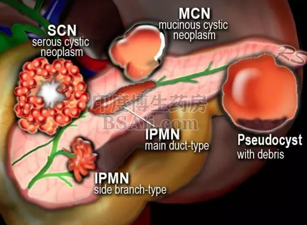 <b>9种治疗胰腺神经内分泌瘤(PNE</b>