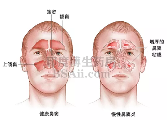 <b>3款治疗慢性鼻-鼻窦炎伴鼻息肉</b>