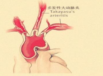 <b>大动脉炎的7种治疗药物</b>药厂实拍